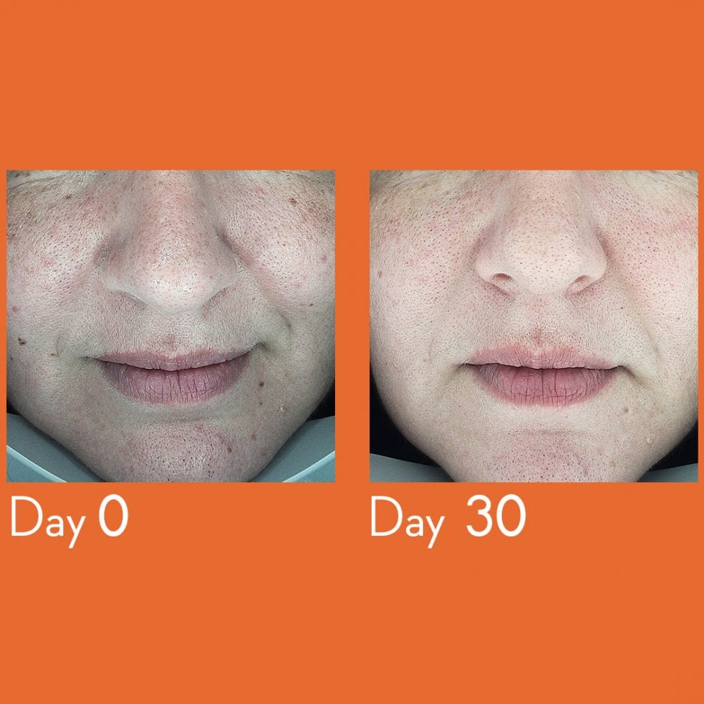 Dark Spot Remover Serum 30ml